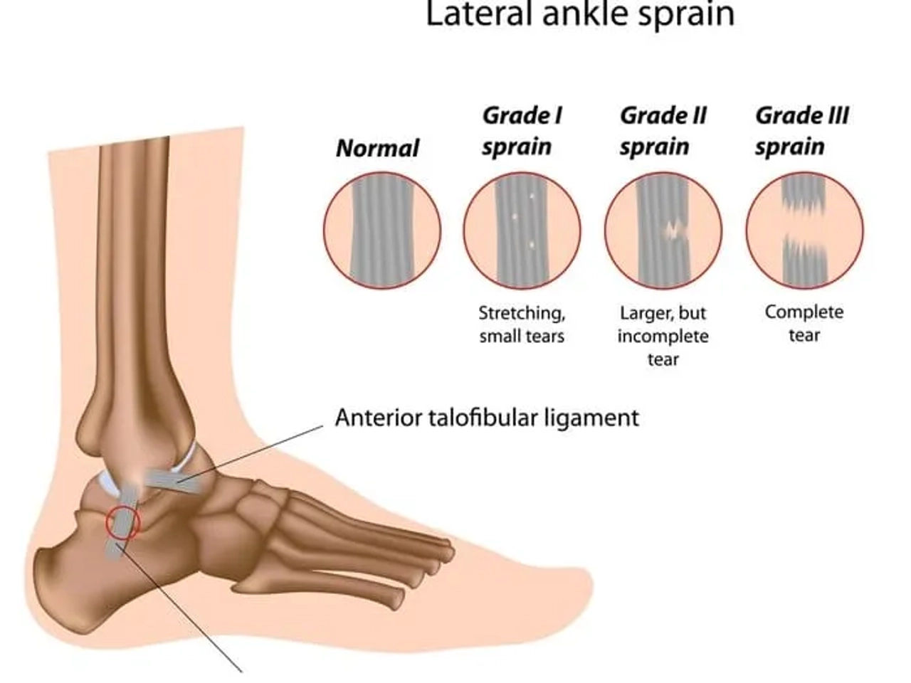 Diagrama de esguince de tobillo lateral, mostrando grados de lesión y ligamentos afectados.