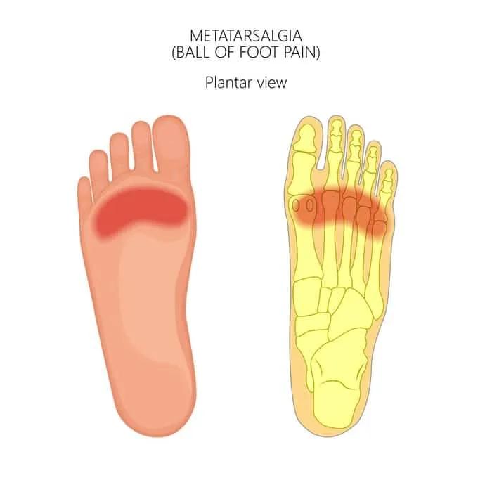 lesiones al viajar