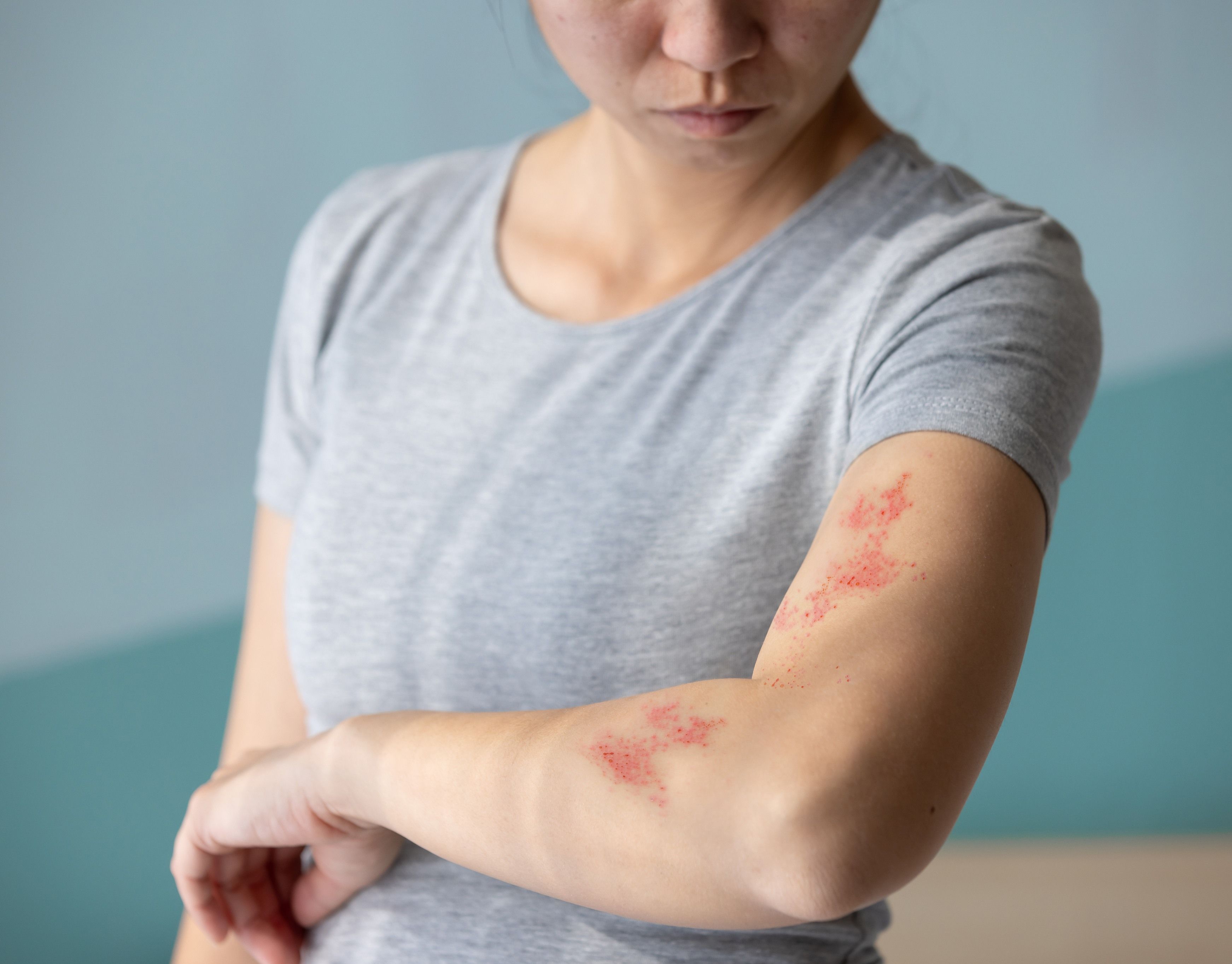 Shingles Vaccinations
