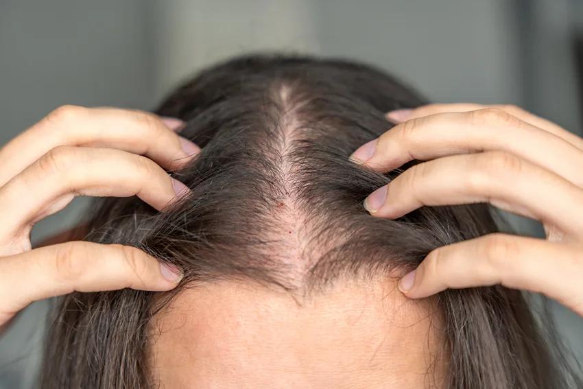 Ilustração delicada mostrando fios de cabelo feminino com rarefação sutil na região central do couro cabeludo, estética clínica premium