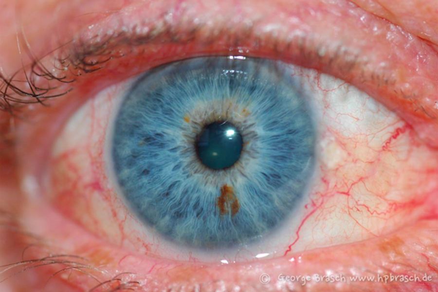 Iris mit Leberfeld