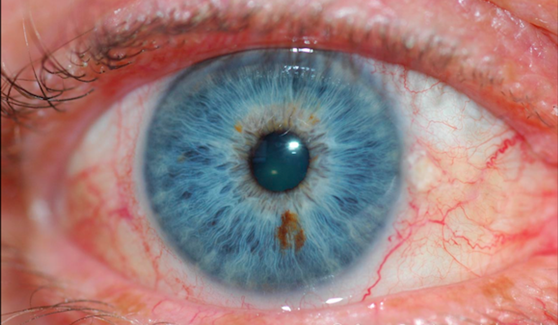 Iris mit Leberfeld