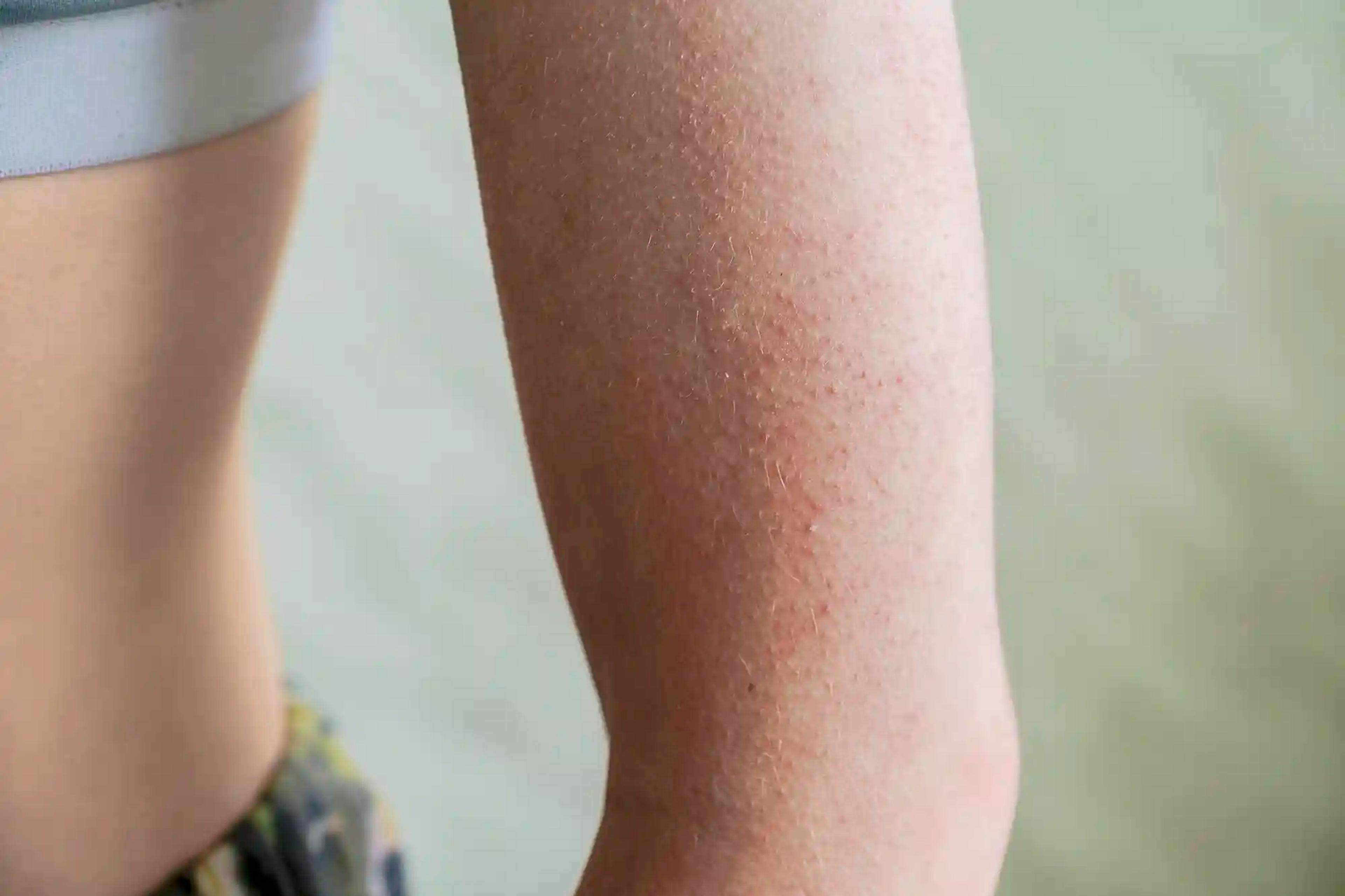 Redness and Red Bumps on Arms (Keratosis Pilaris): How To Get Rid of Bumps on Arms
