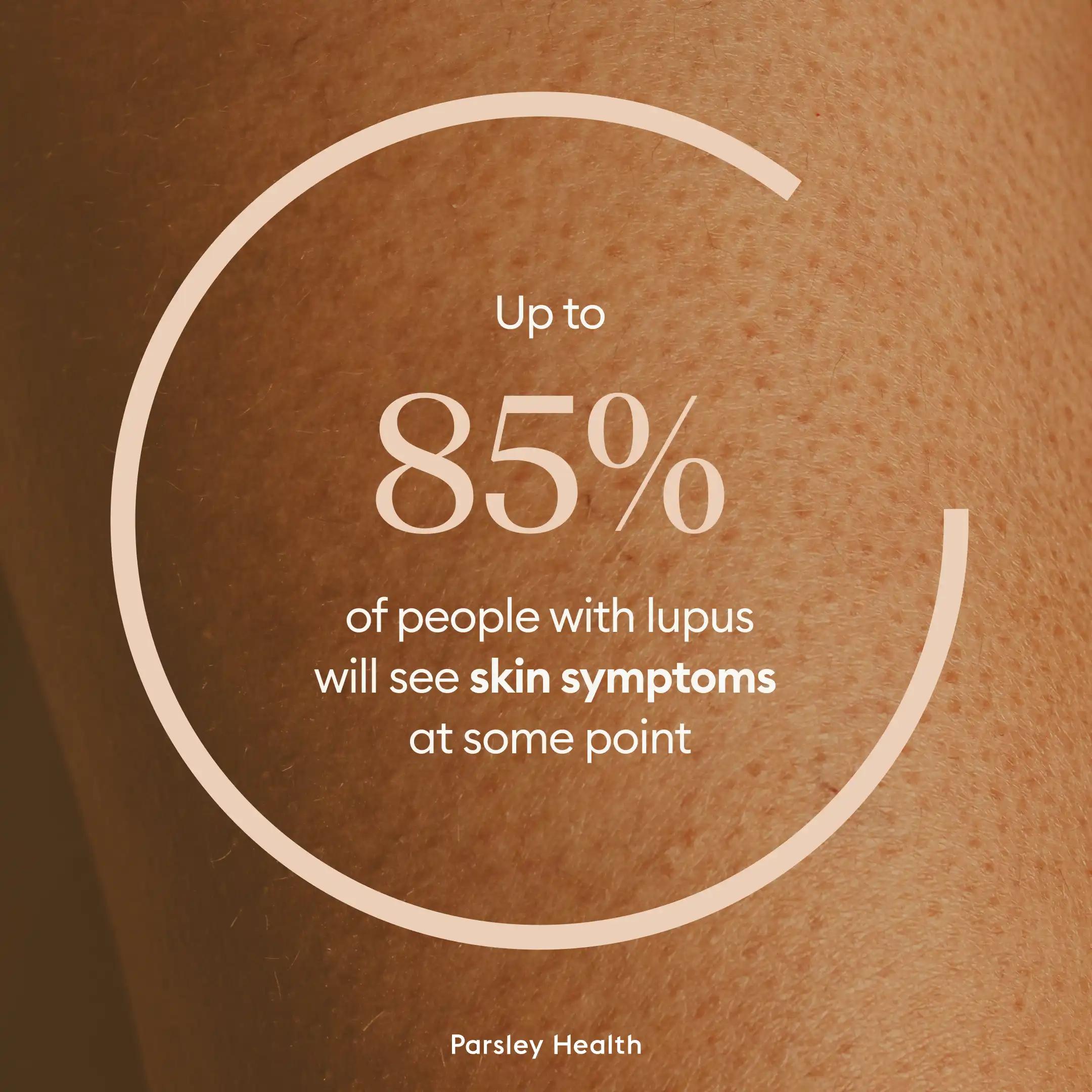 85% of people with lupus will see skin symptoms at some point