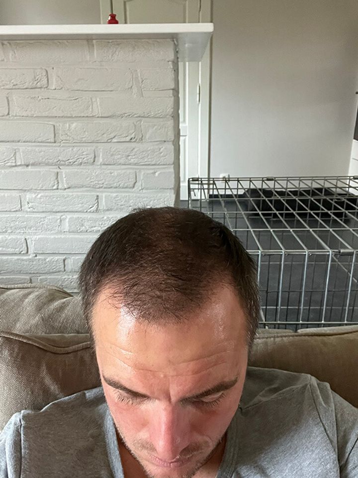 nico voor haartransplantatie