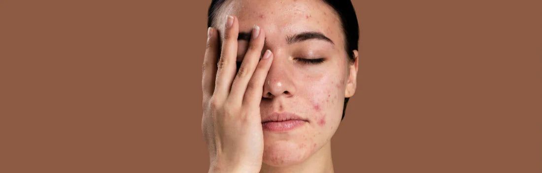Borbulhas causadas pelo calor: por que surgem surtos de acne no verão e como preveni-los