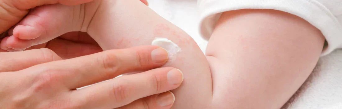 Sudamén em bebés: tratamento e cremes recomendados