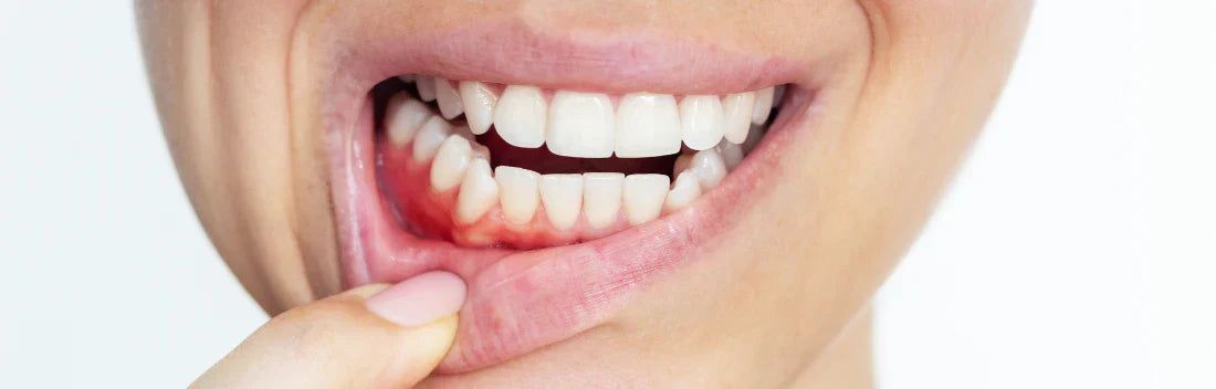 Sangramento nas gengivas: causas e tratamento para melhorar a saúde das gengivas