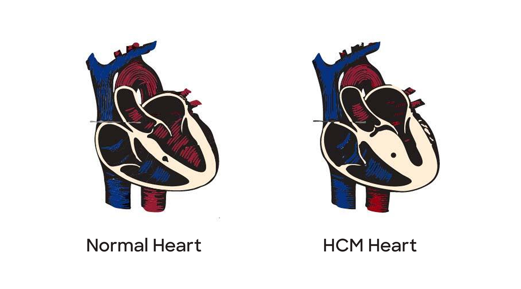Normal Heart image vs. HCM Patient Heart image