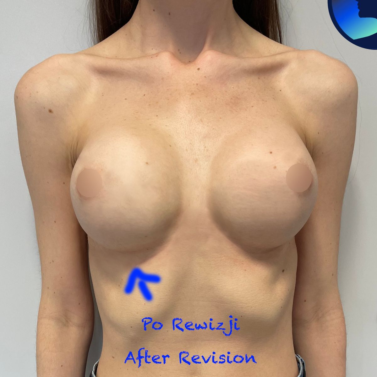 After surgery