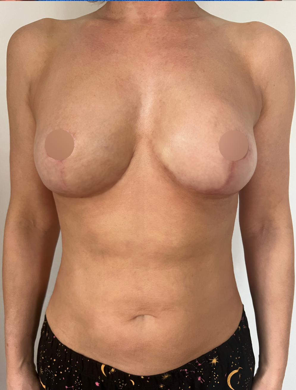 After surgery