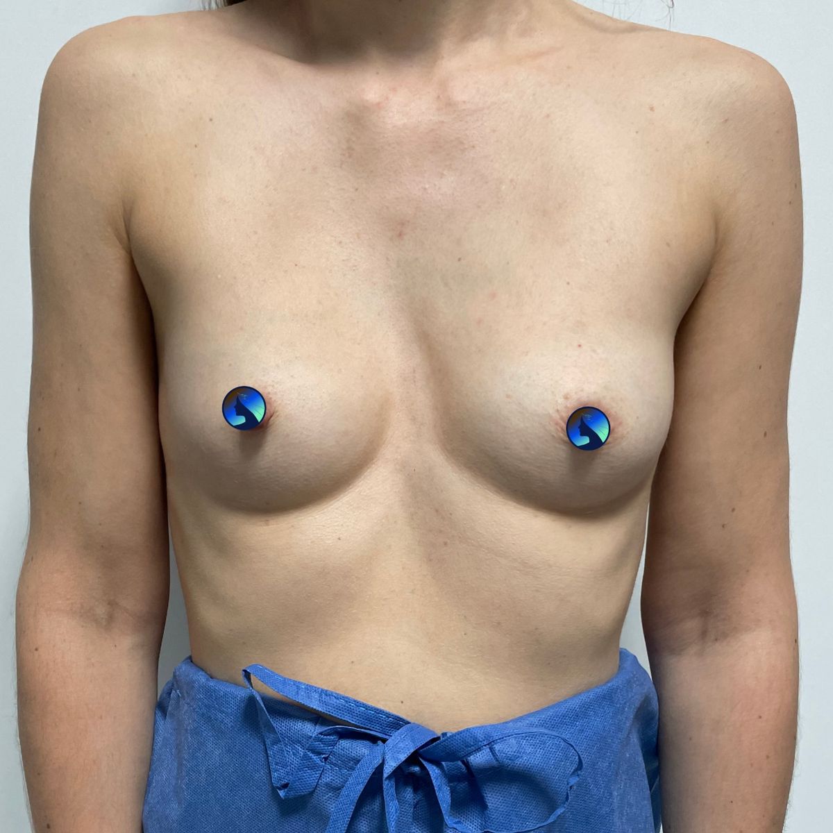 Przed operacją