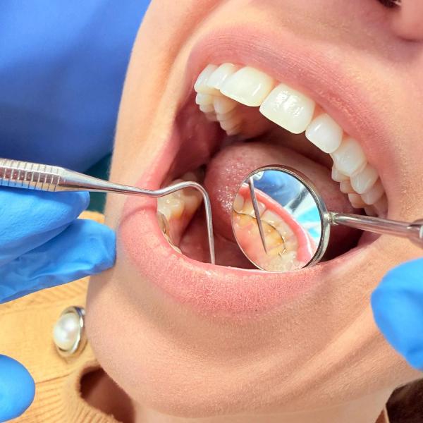 Examinare dentară cu oglinda intraorală