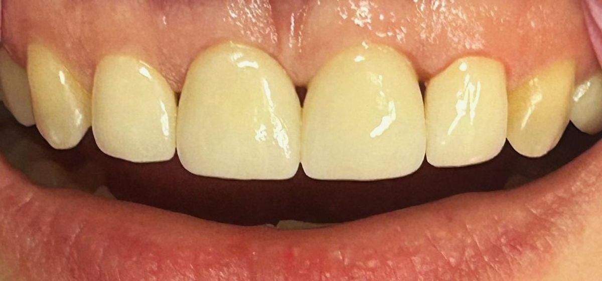 Zirconia or metal-ceramic crown: which is better?