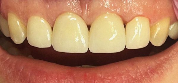 Zirconia or metal-ceramic crown: which is better?