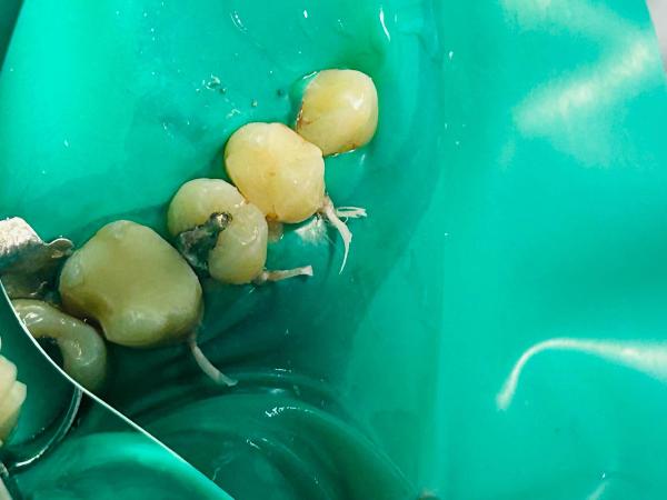 Dental implant or bridge: what to choose for a missing tooth?