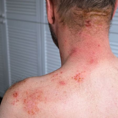 Shingles (Herpes Zoster)