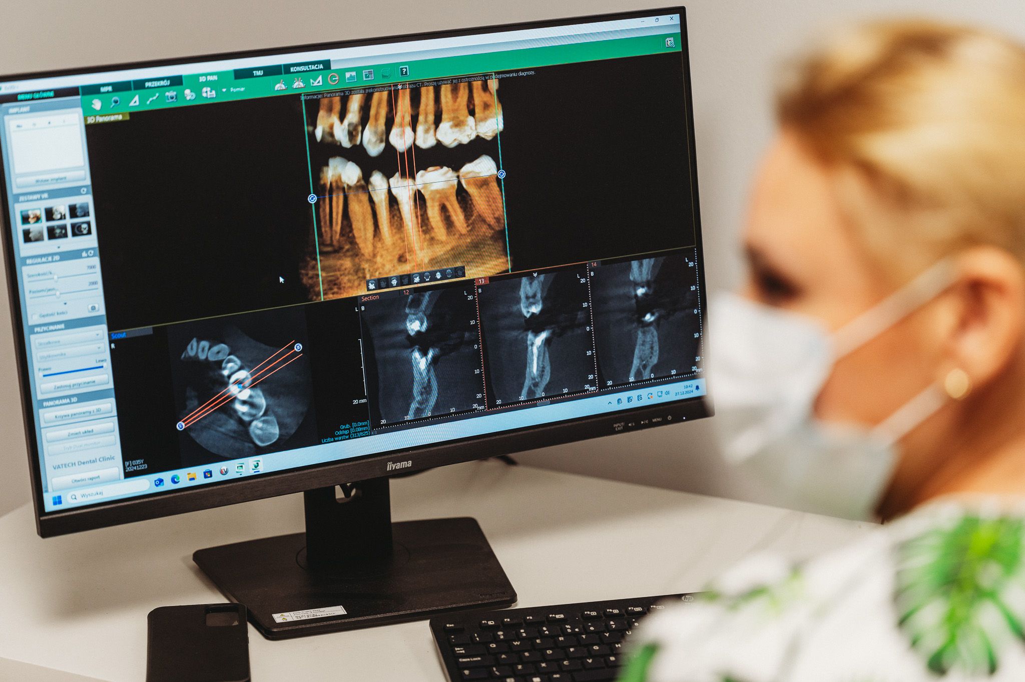 Kiretaż i gingiwektomia