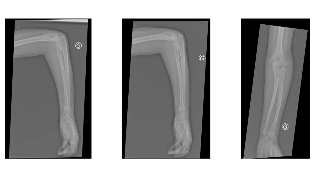 Cas clinique de détection de fracture par IA