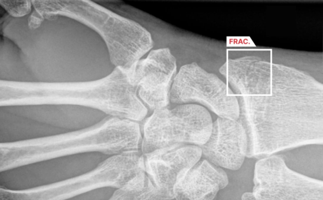 Impact of AI on fracture detection in radiology