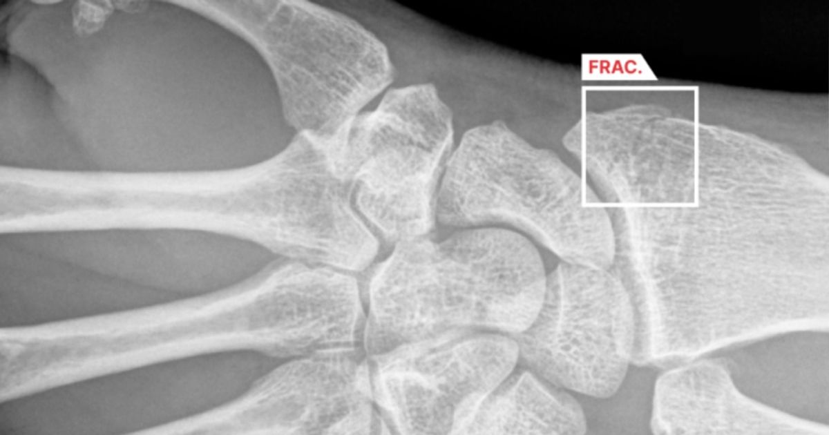 Impact of AI on fracture detection in radiology