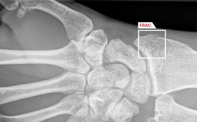 Impact of AI on fracture detection in radiology