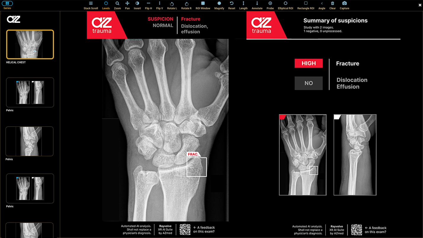 ai for fracture detection