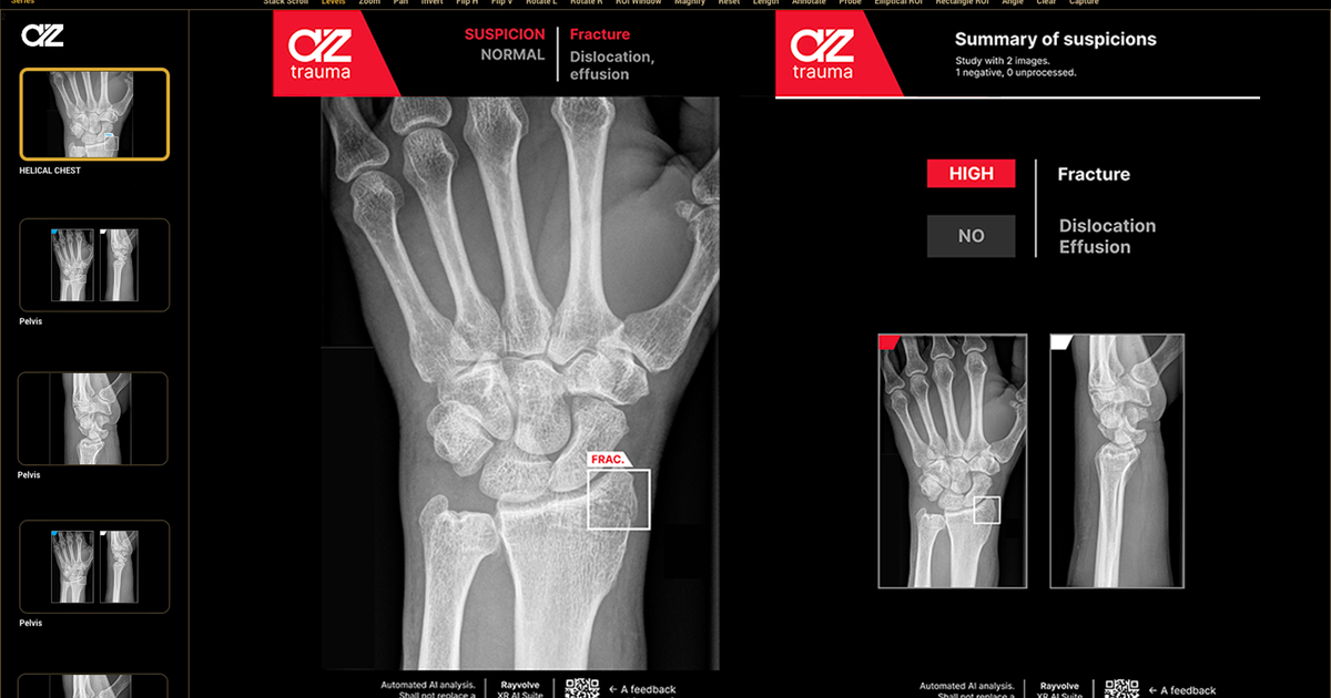 ai for fracture detection