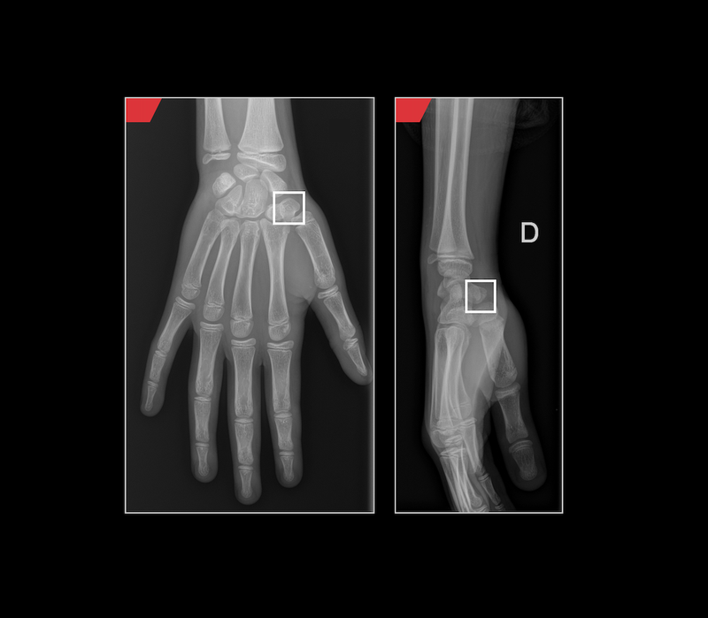 AZmed secures FDA 510(k) clearance for Rayvolve in pediatric fracture detection AI