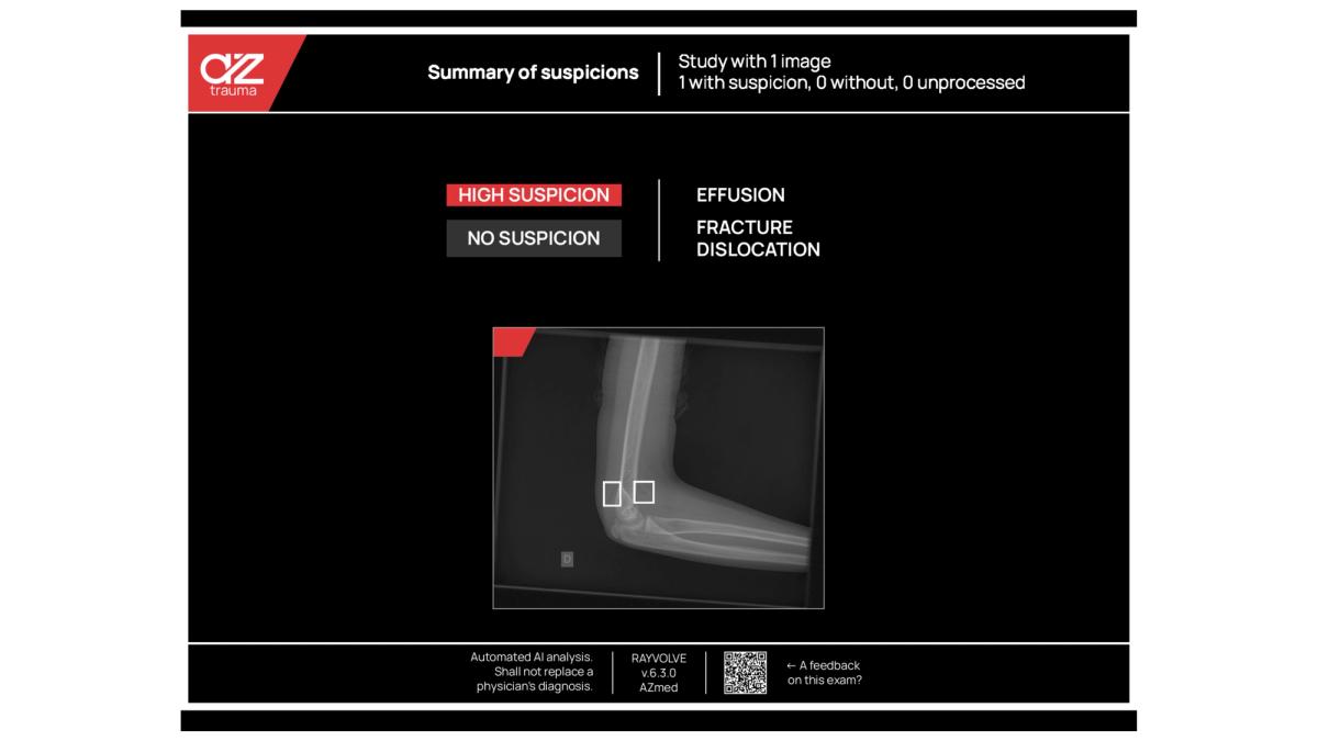 Synthèse clinique de l'analyse de fracture par IA