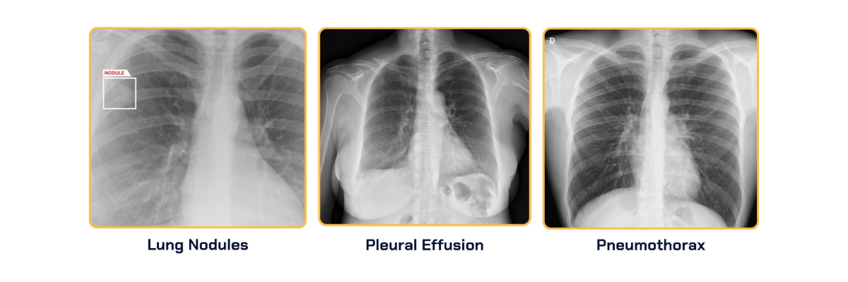 AZmed receives two new FDA clearances for Its AI-powered chest X-ray solution