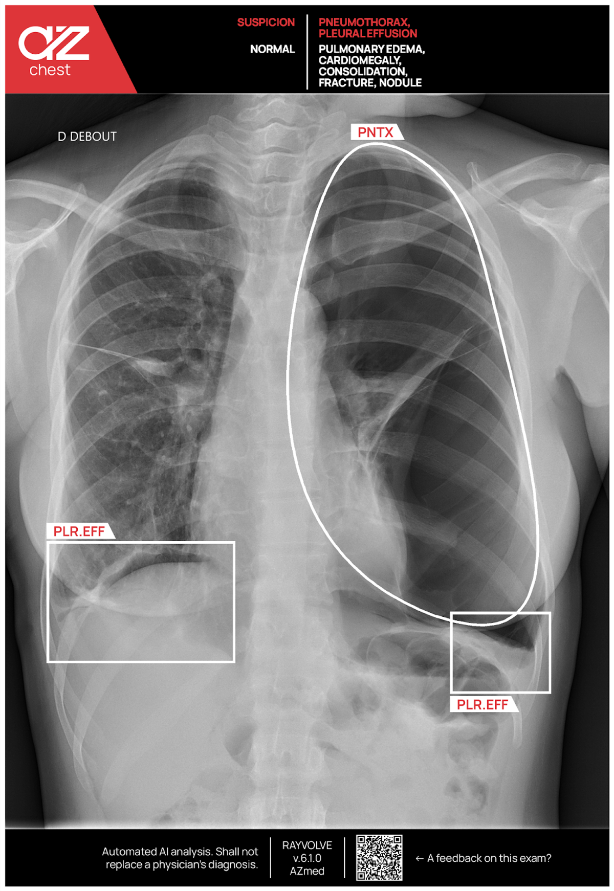 IA pour la détection thoracique en radiologie