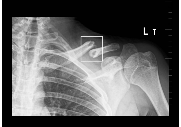Fracture spotted by AZtrauma AI