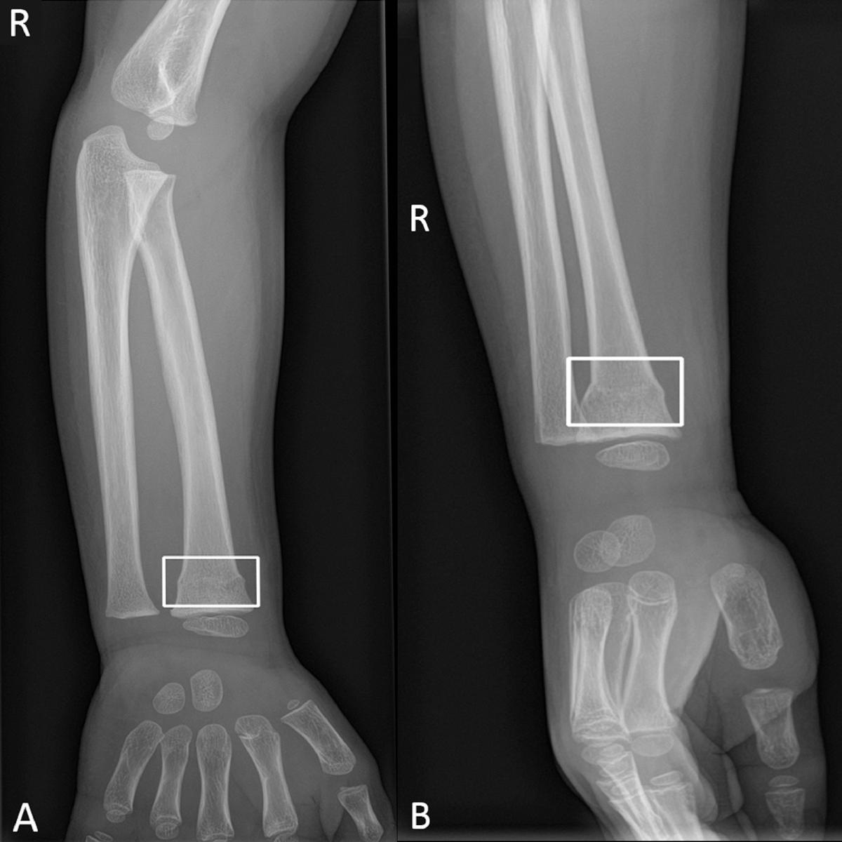 détection des fractures par IA