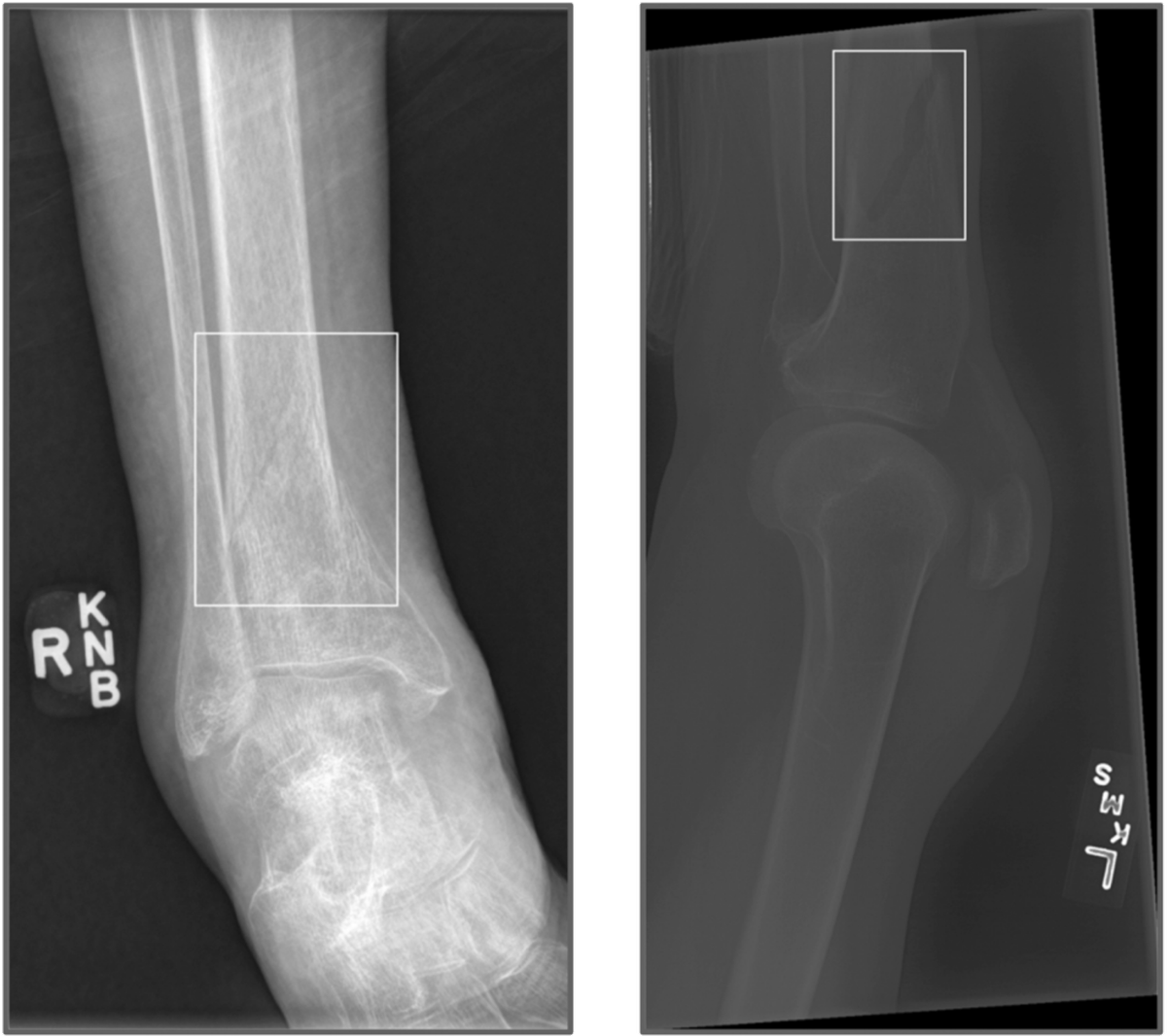 ai radiograph trauma