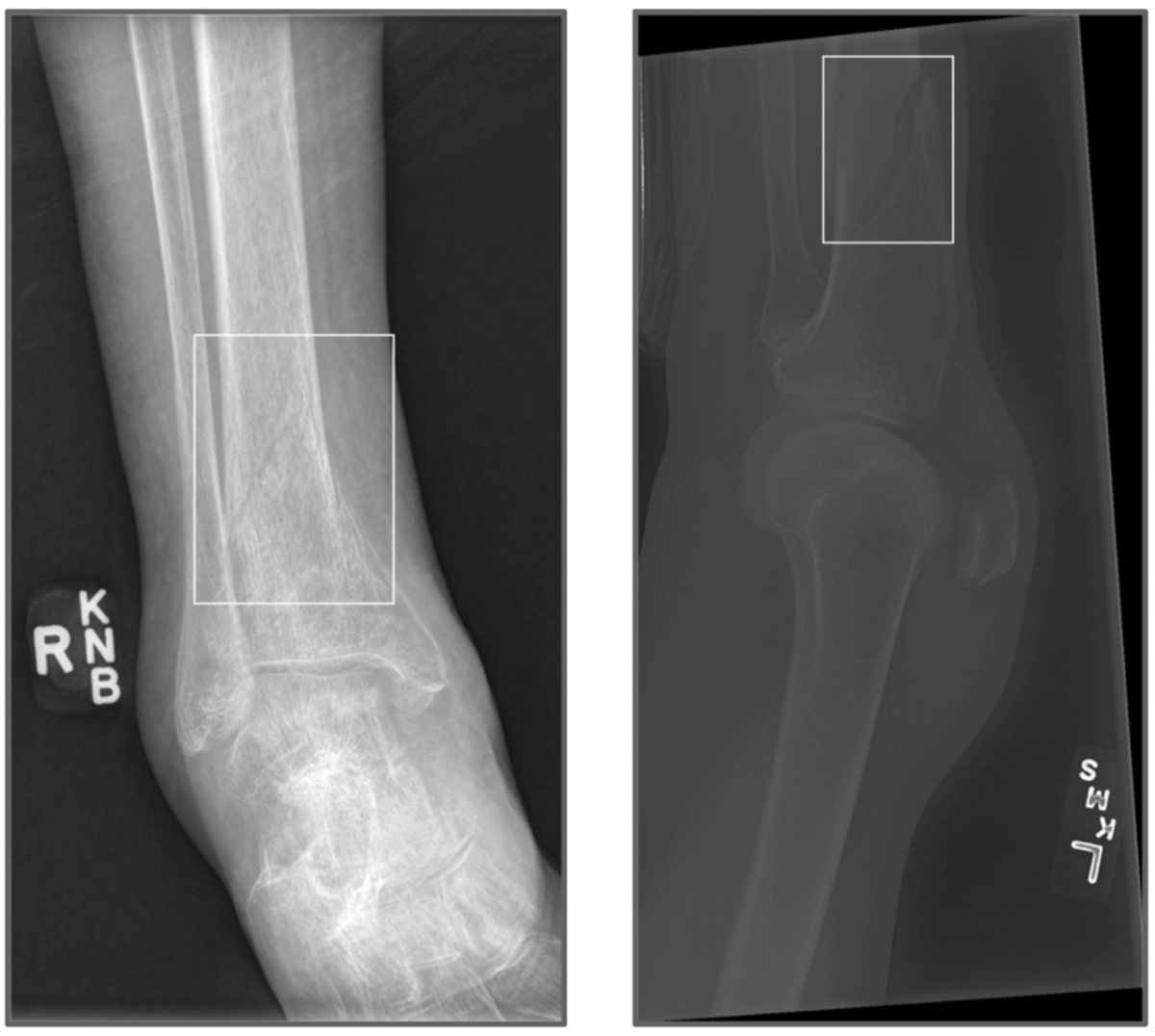 Radiographies avec suspicion de fracture détectée par l'algorithme d'IA