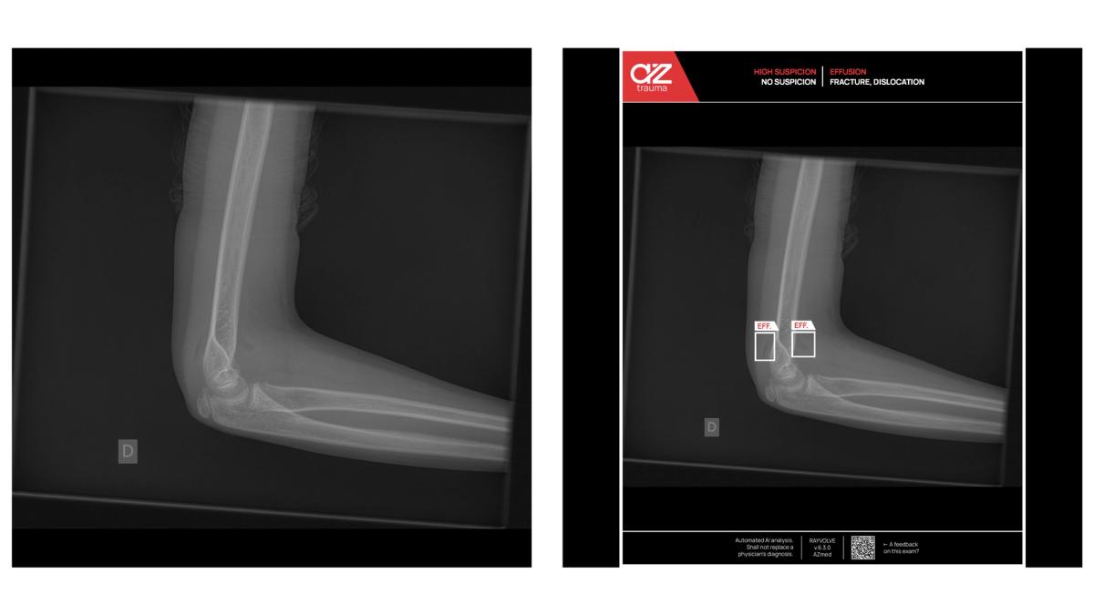 Cas clinique d'analyse de fracture par IA