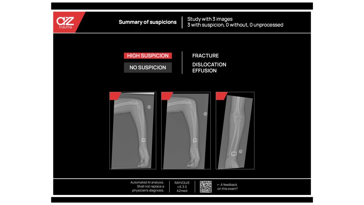 Synthèse clinique en détection de fracture par IA
