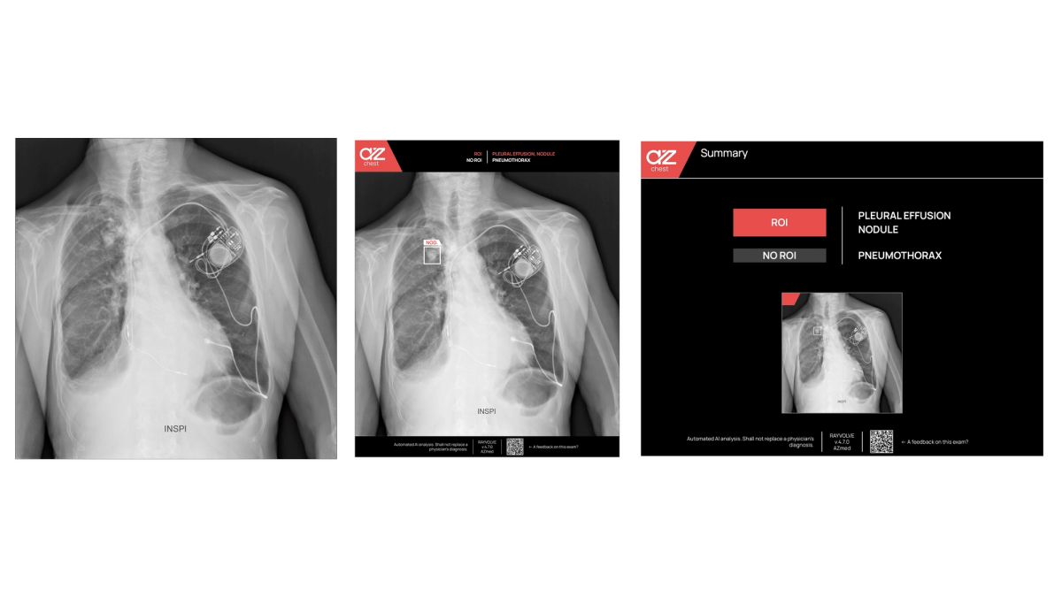 Nodule detection in Chest Radiography with Artificial Intelligence