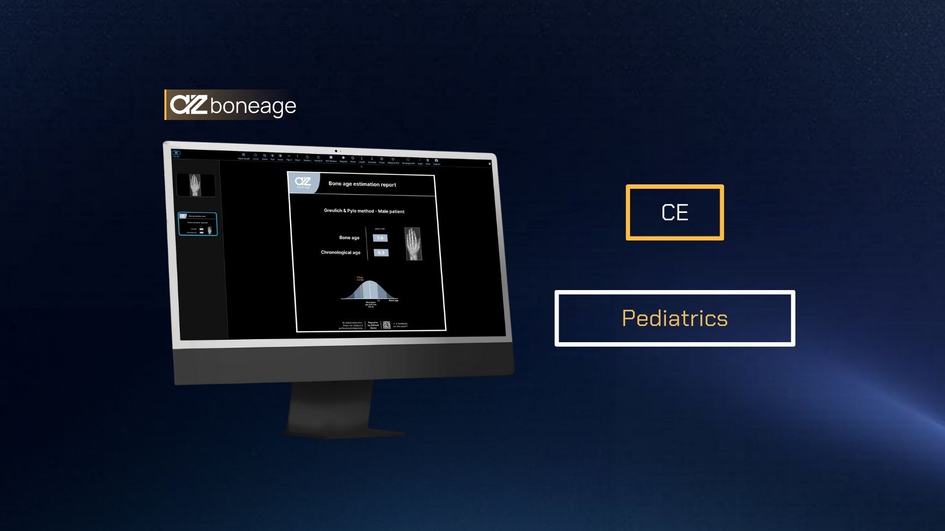 AZboneage: AI for pediatric bone age
