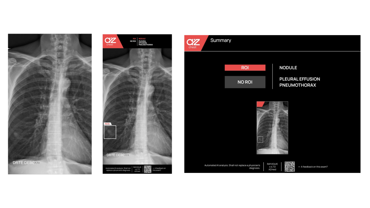 Nodule Cancer Detection with AI