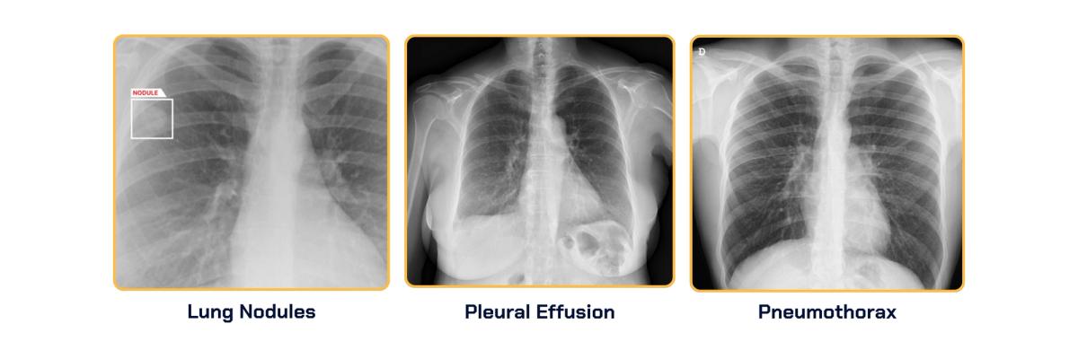 AZmed obtient deux nouvelles autorisations FDA pour sa solution de radiographie thoracique par IA