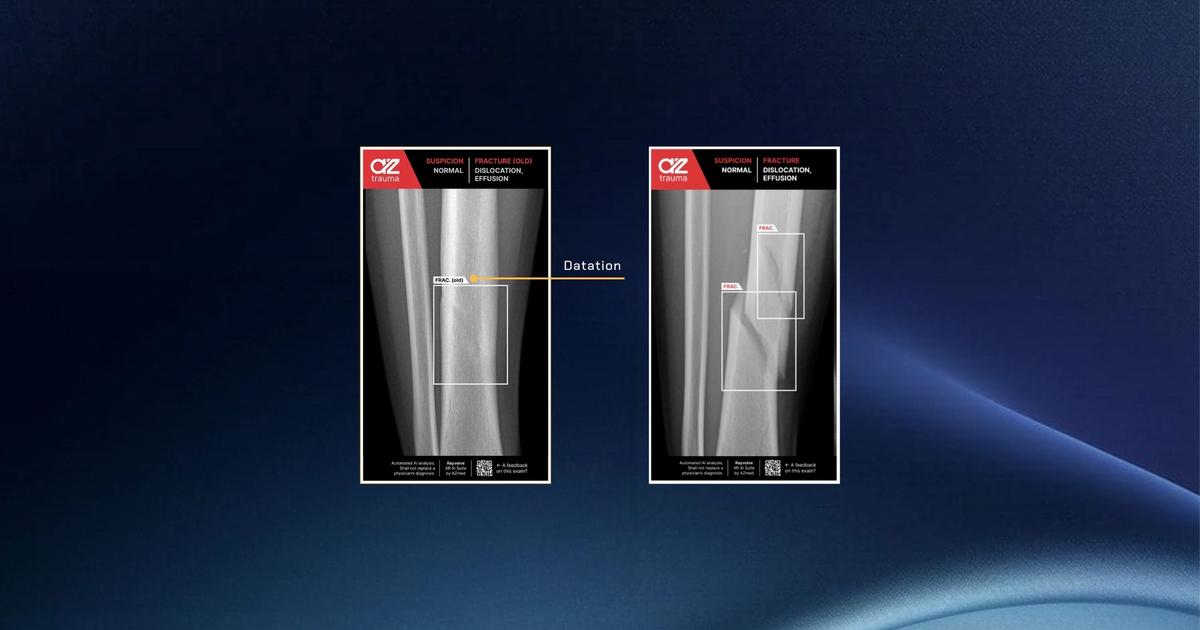 AZtrauma’s New Fracture Datation Feature Launched