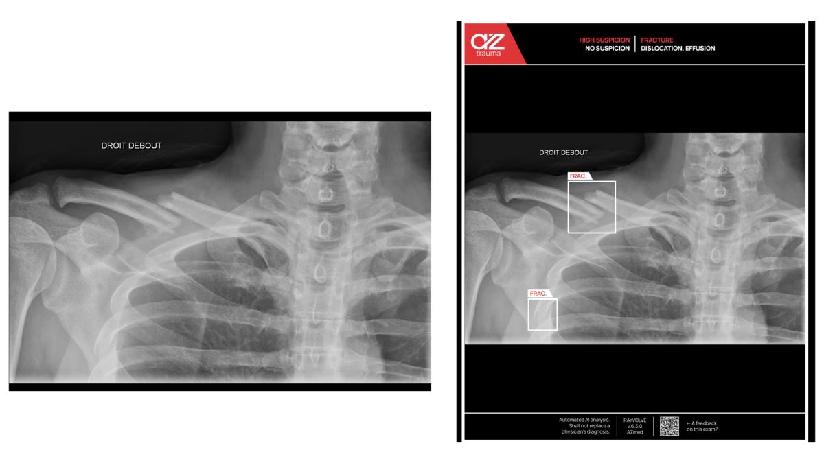 Fracture détectée par IA avec AZtrauma