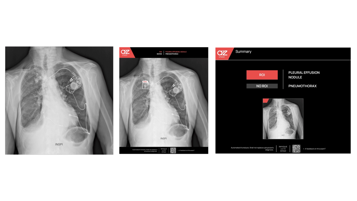 Détection de nodule en radiographie thoracique par intelligence artificielle