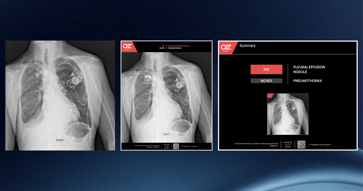 AI for chest detection in radiology