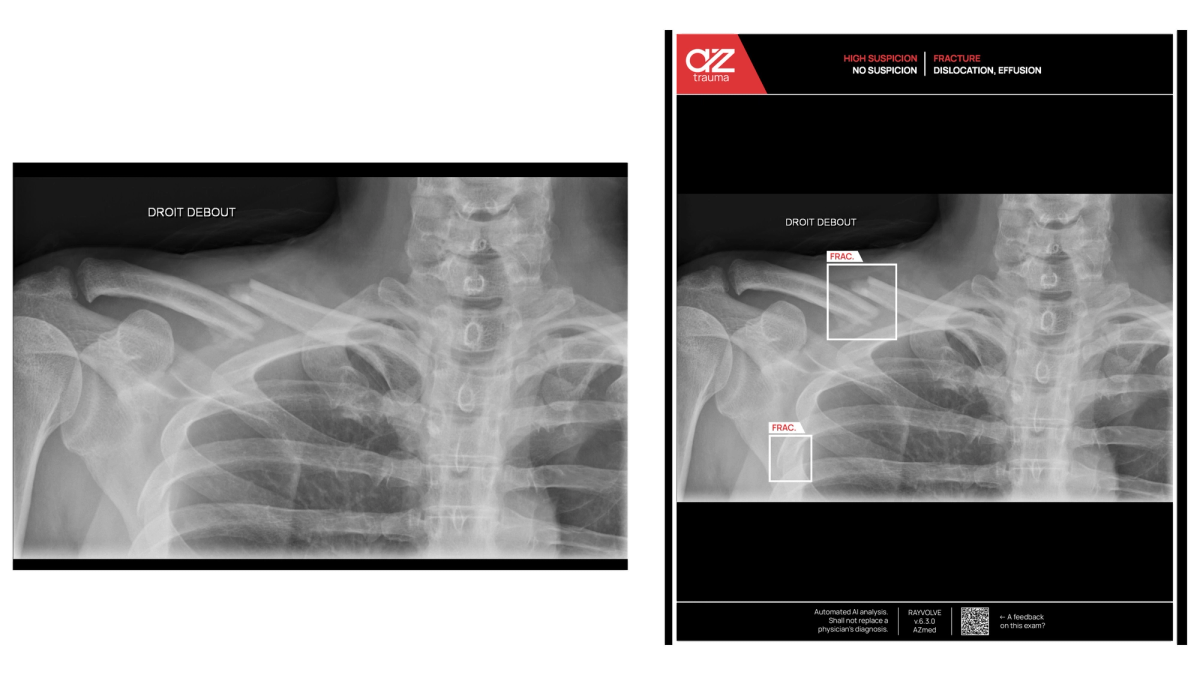fratura detectada por IA com AZtrauma