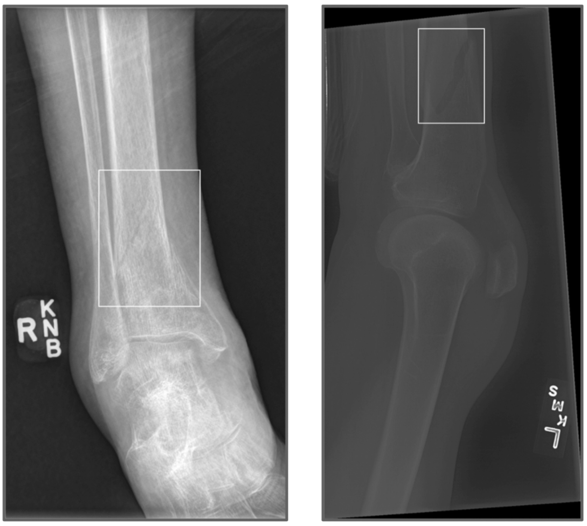 Radiografias com suspeita de fratura detectada pelo algoritmo de IA
