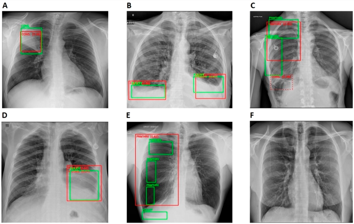 AI in Chest Detection and Care