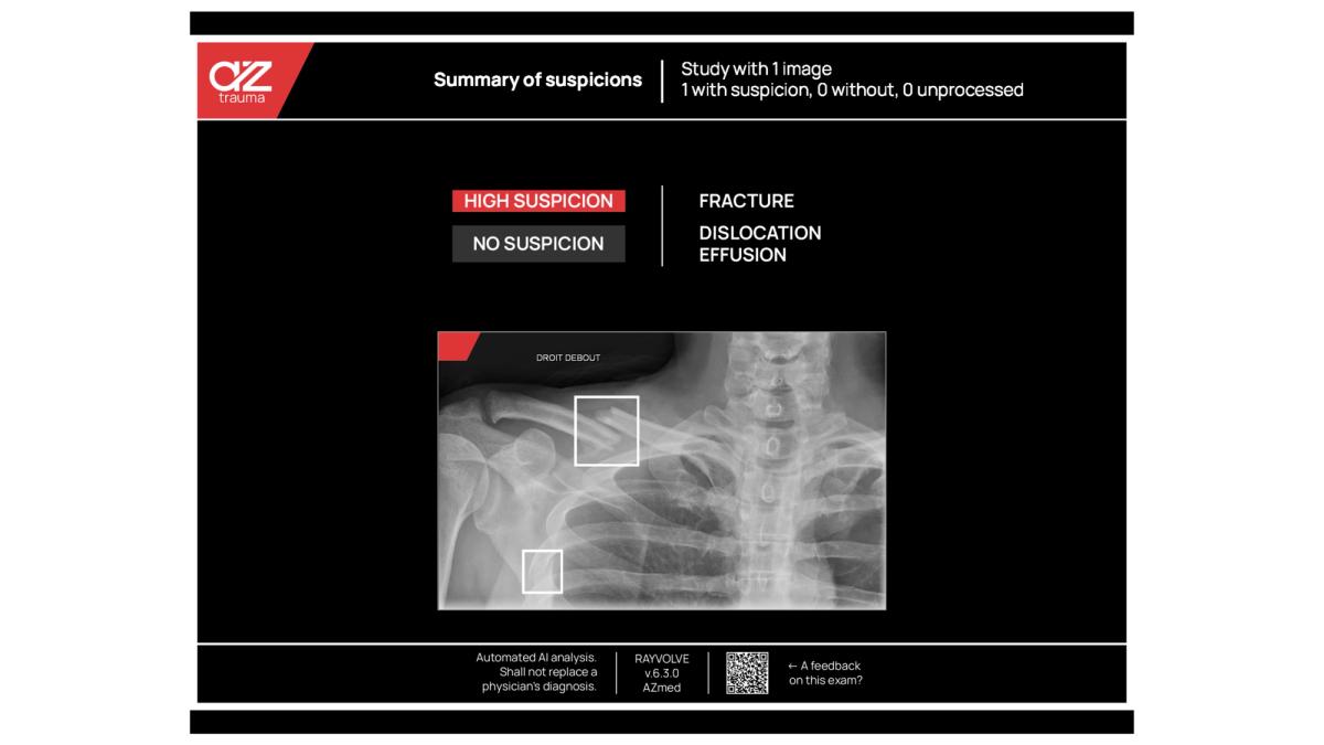 Synthèse de détection de fracture par IA avec AZtrauma